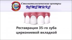 Реставрация 35 го зуба циркониевой вкладкой