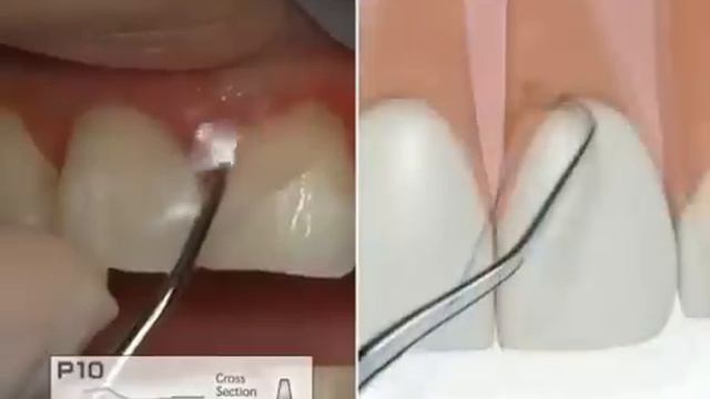 Varios970 Ультразвуковой скалер NSK