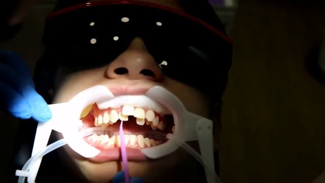 Металлические брекеты, установка в Днепре цена