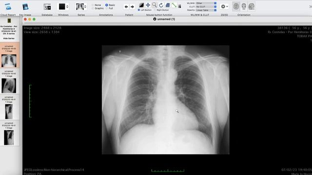 HOROS DICOM - TUTORIAL смотреть онлайн
