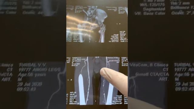 Ангиография ноги. Описание снимка.