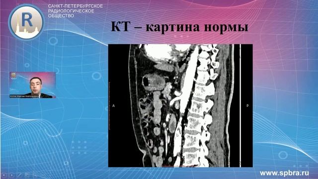 Синдром Уилки, как  причина абдоминальной боли, в практике врача рентгенолога.  НРФ XIII - 2022.
