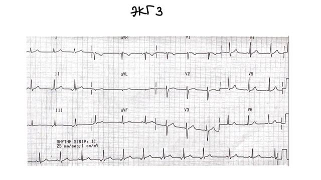 Учимся определять ритм. Пошаговая инструкция и ЭКГ примеры. Анализ ЭКГ.