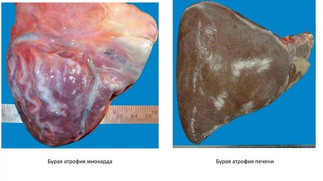 01-06 Нарушения обмена пигментов. Патологическое обызвествление. Камнеобразование. смотреть онлайн
