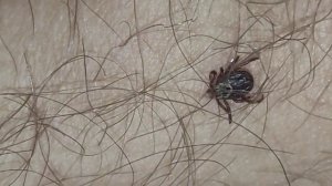 Клещ Впился в Человека #осторожно #клещ