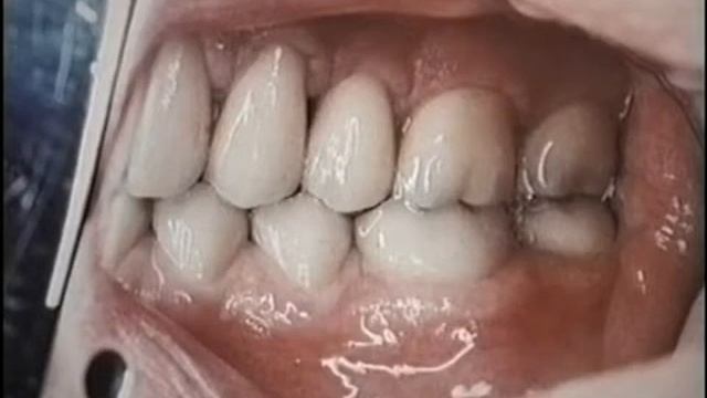 Лекция по ортопедической стоматологии Масахиро Кувата часть 4