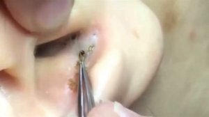 ОГРОМНЫЕ чёрные ТОЧКИ в ухе / УДАЛИТЬ / Blackheads on ear / REMOVAL