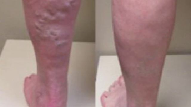 склеротерапия Вищипанов СА