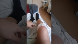 четвёртый день после удаления штифта с большой берцовой кости