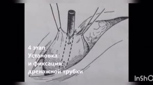 Эпицистостомия- Демеуова Ф.