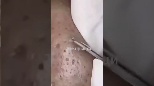 Самое залипательное видео давить прыщи Черные точки