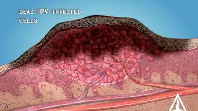What Are Warts (HPV)? - 3D Animation