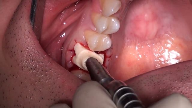 Sinus lift alternative, revolutionary dental implant placement - no surgery. смотреть онлайн