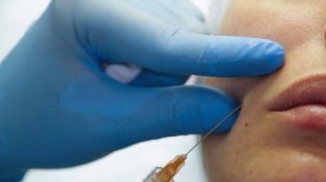 Носогубные складки. Канюля. Overage Deep (Mesotech, Italy)