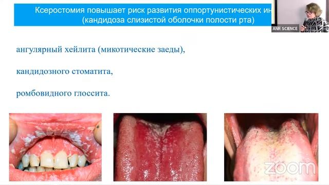 Профилактика в реабилитации  у пациентов с диабетом и предраковыми заболеваниями полости рта