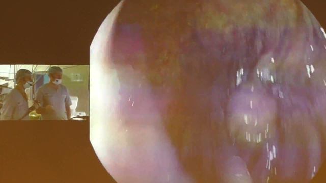 04Live Ткаченко ОБ Рак толстой кишки cT1N0M0 EFTR эндоскопическаяполностенная резекция смотреть онлайн