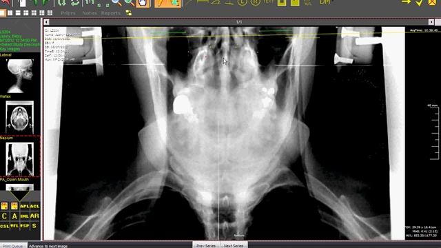 X-ray analysis of Angular Rotation (AR) смотреть онлайн
