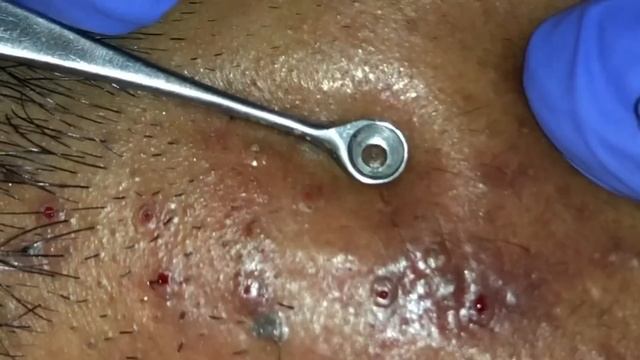 Deep Blackheads Part-1 By Dr.Lalit Kasana (30 July 2019)