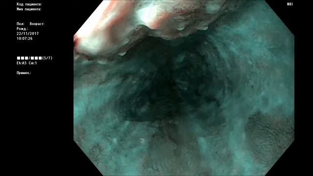 Рак пищевода м  1963 г р