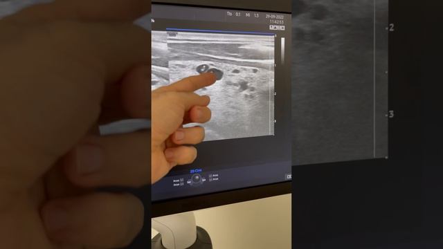 Узлы в щитовидной железе при Узи сонных артерий. Узи сосудов. Сосудистый хирург. Флеболог Москва смотреть онлайн