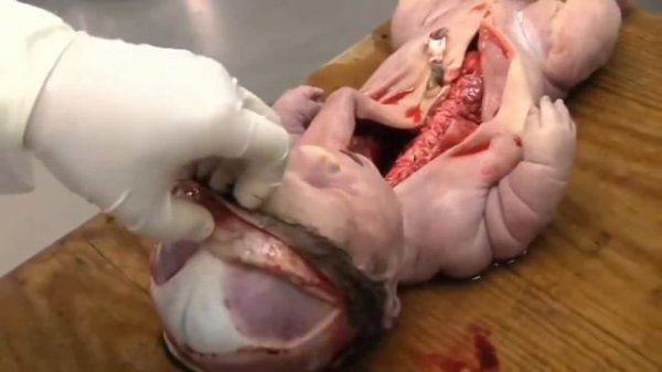 Neonatal autopsy