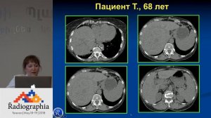 Очаговые образования печени на примере клинических наблюдений. Анна Кудрявцева