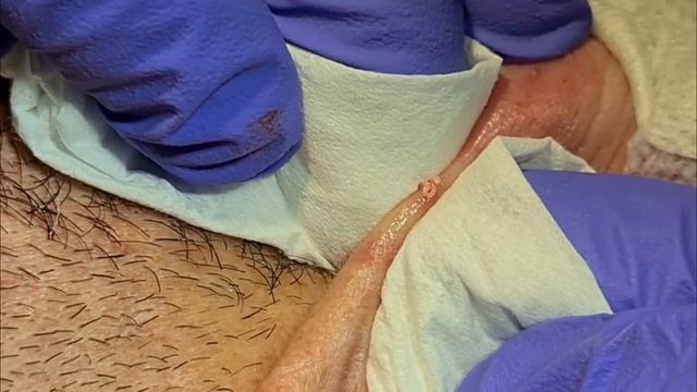 Whiteheads, Blackheads Extractions on the Ear смотреть онлайн