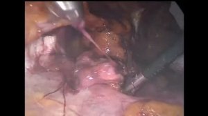 eTEP герниопластика паховой грыжи.