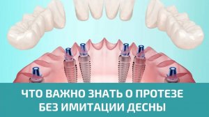 Протезирование на имплантах без имитации десны