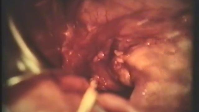 Хирургия язвенной болезни 12-перстной кишки © Surgery of peptic ulcer disease 12 duodenal ulcer смотреть онлайн