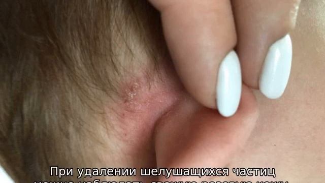 Сухие корочки за ушами у ребенка и шелушение — что делать смотреть онлайн