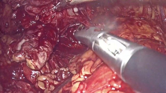 простатэктомия после TAPP // laparoscopic prostatectomy after previous TAPP hernia repair смотреть онлайн