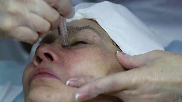 Фракционная мезотерапия аппаратом дермапен смотреть онлайн