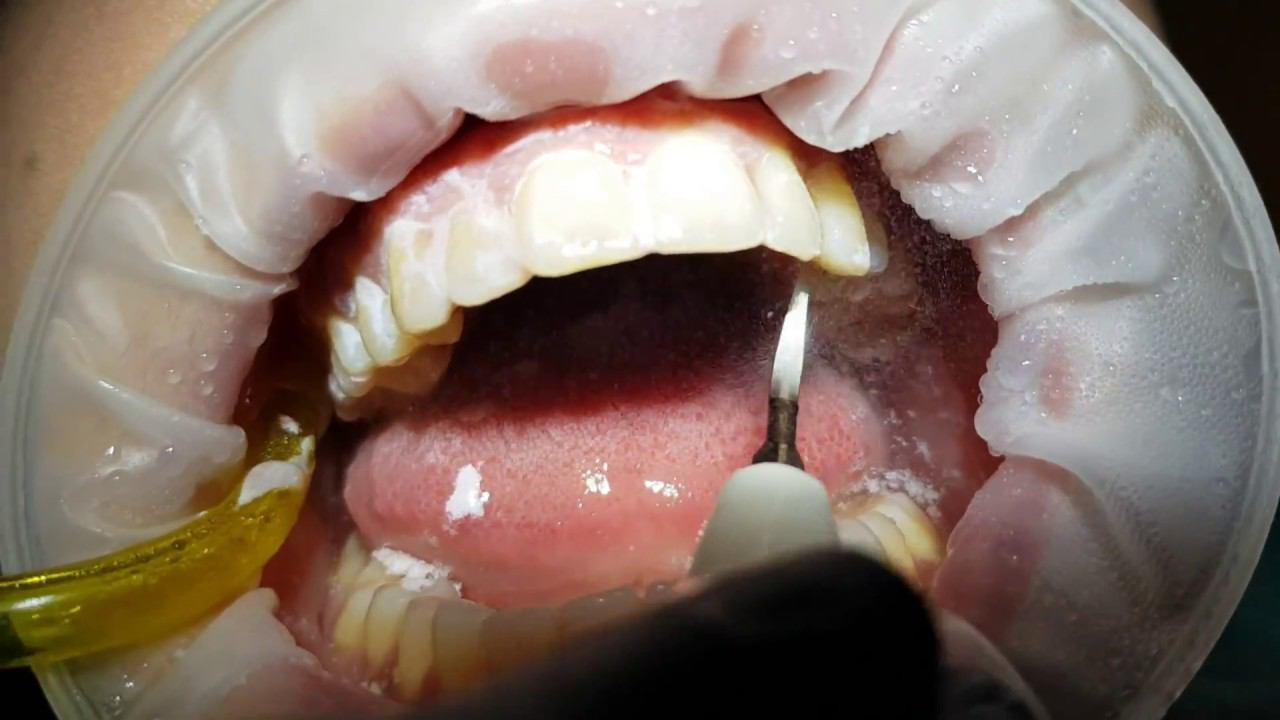 чистка зубов Air Flow смотреть онлайн