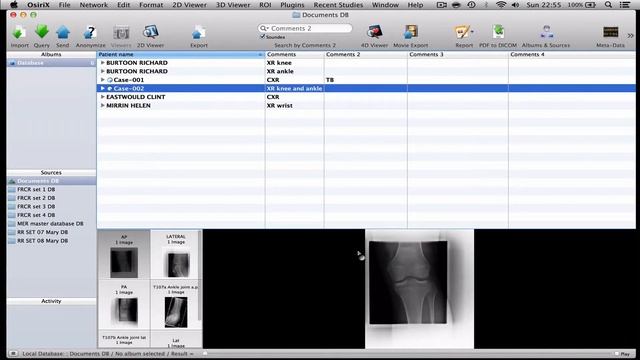 How to prepare and share databases in OsiriX смотреть онлайн