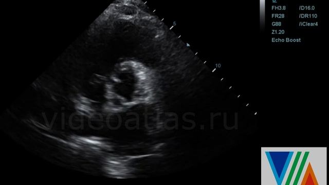 Ошибка определения стеноза АК по сепарации створок АК в парастернальной позиции по длинной оси ЛЖ смотреть онлайн