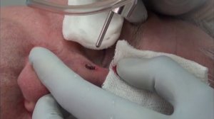 Биопсия и удаление СО2-лазером базалиомы кожи спинки носа.