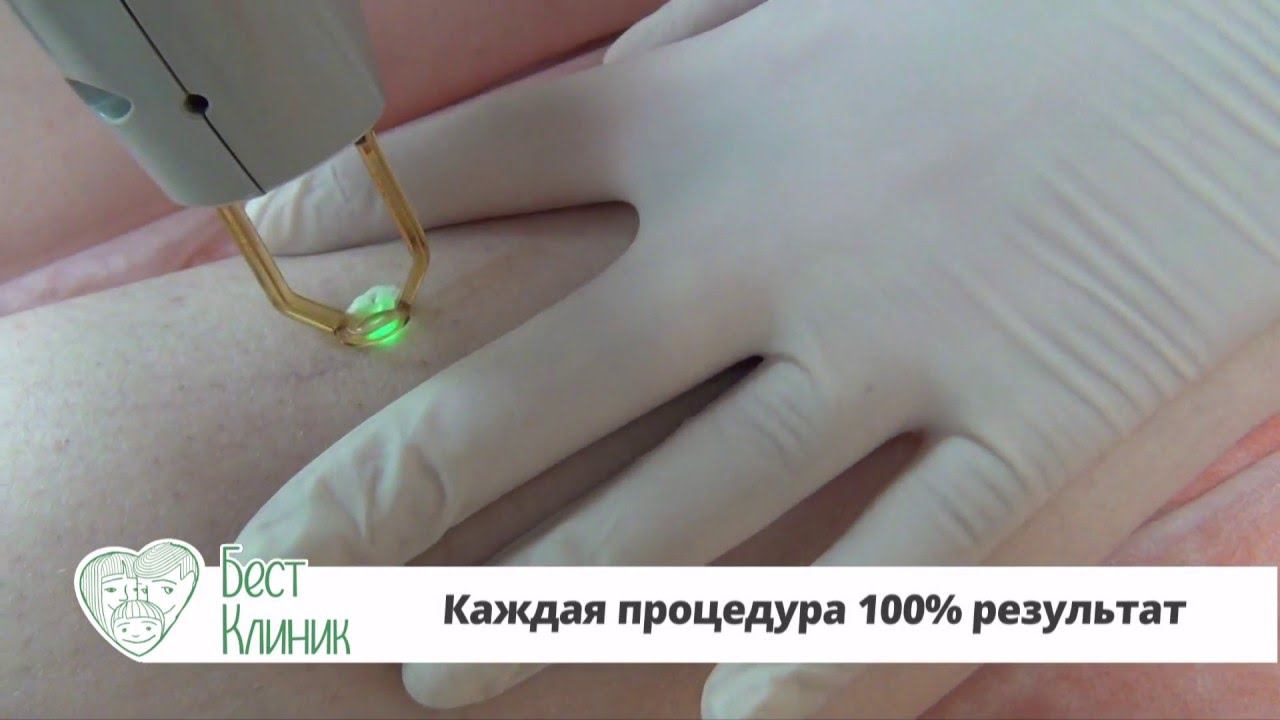 Лазерное удаление сосудистых звездочек смотреть онлайн