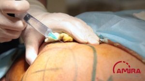 Удаление холки. Хирург- Сабазбеков Ч.С. Казахстан