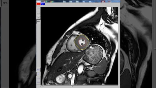 Left Ventricle Segmentation at ES смотреть онлайн