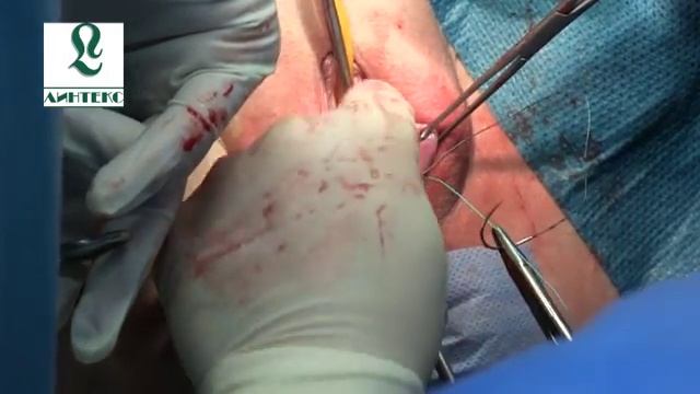 Комбинированная хирургическая реконструкция тазового дна в двух компартментах