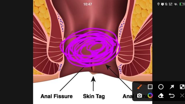 Lower GIT Surgery 15 | Pilonidal Sinus+ Anal Fissure смотреть онлайн