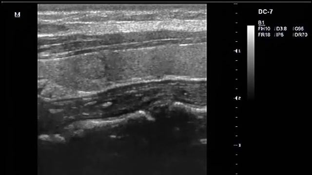 Видеозапись УЗИ - Солидный узел - TIRADS 3 смотреть онлайн