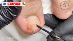 Сложный вросший ноготь / как убрать вросший ноготь / врастающий ноготь в кожу / подолог Москва