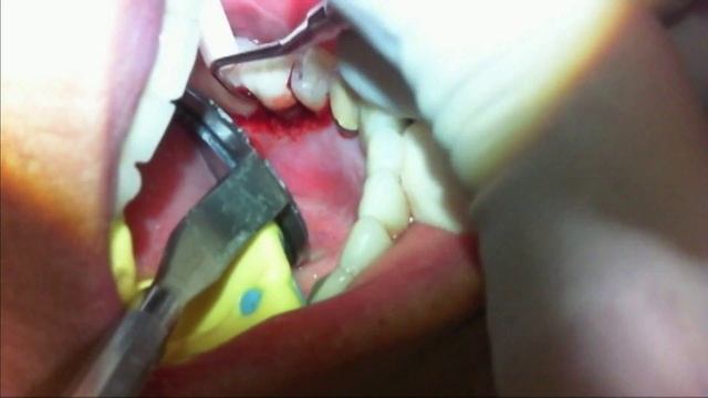 LAPT/DEEP POCKET THERAPY LL-Dr. Stephen R. John смотреть онлайн