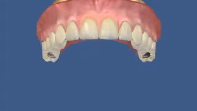 Ортопедия бюгельный протез для верхних резцов смотреть онлайн