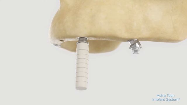 SmartFix-Konzept für Astra Tech Implant System EV – OsseoSpeed Profile EV смотреть онлайн