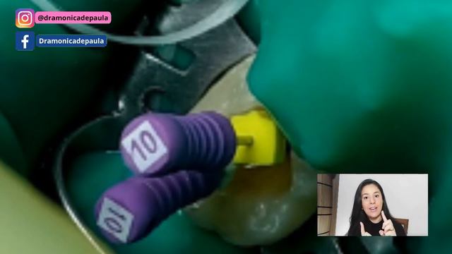 Tratamento De Canal: Como é Feito O Tratamento De Canal Passo A Passo/ Dentista Que Fez Mostrou TUD