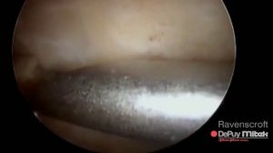 Субакромиальная декомпрессия и резекция акромиально-ключичного сустава (Subacromial decompression)