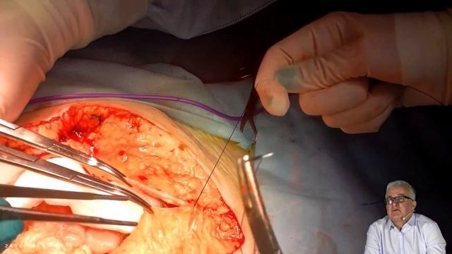 Техника ушивания продольной лапаротомии смотреть онлайн